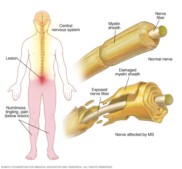 nerve-affected-by-MS