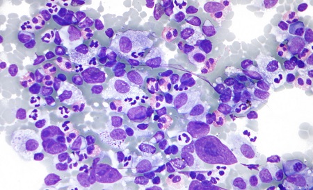 non-hodgkins-lymphoma